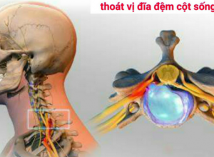 12 bài tập chữa thoát vị đĩa đệm cột sống cổ c5 c6 đơn giản, hiệu quả